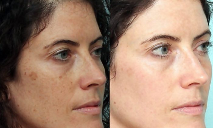 Yüzdeki Kahverengi Lekeler Nasıl Geçer?